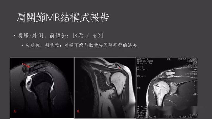 肩關節mri報告如何規範書寫