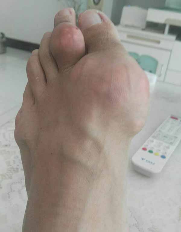 痛风一般是怎么回事你了解了吗