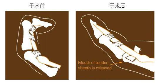 术后3天,王阿姨来院复诊,大拇指又可以灵活地屈伸了.