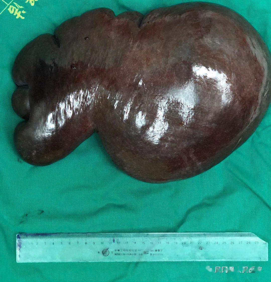 腹部外科完成一例巨大脾脏切除术