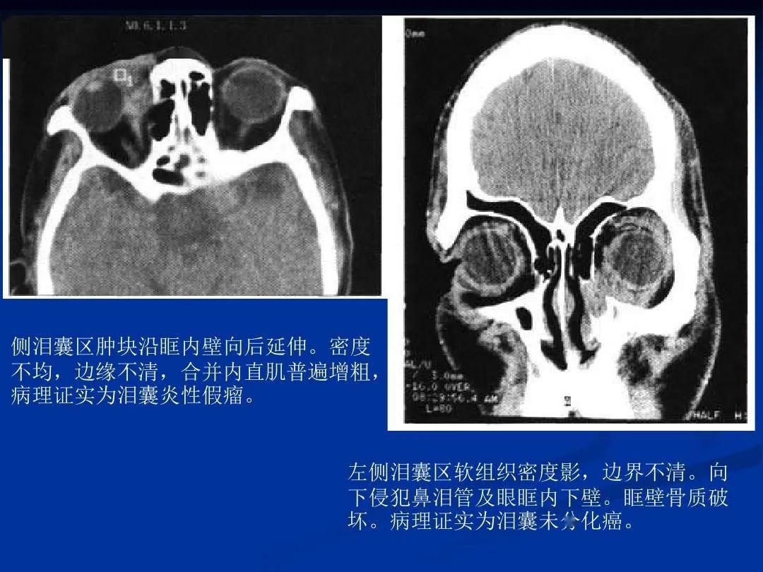 泪器解剖及相应疾病鉴别诊断