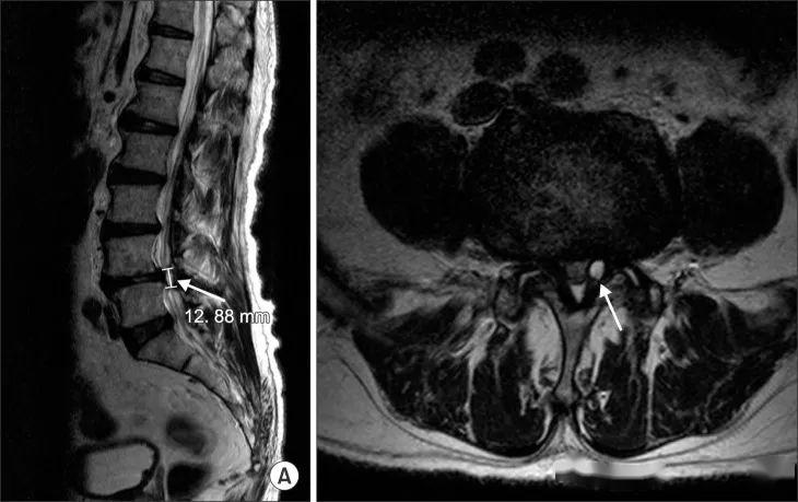 千万不要误诊了看过就会椎小关节滑膜囊肿facetjointsynovialcysts