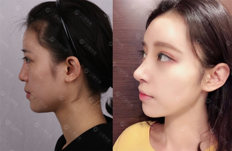 上海华美h100案例招募动人眼鼻助力稳占c位案例招募中