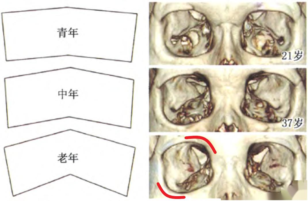 面部骨骼衰老的过程图图片