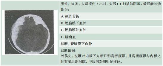 记忆:急性硬膜下血肿=外伤史 颅骨内板下的新月形高密度影,伴中线移位