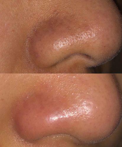 的作用,石泽研究所将这一成分加以改良,使它可以更好的软化角栓黑头