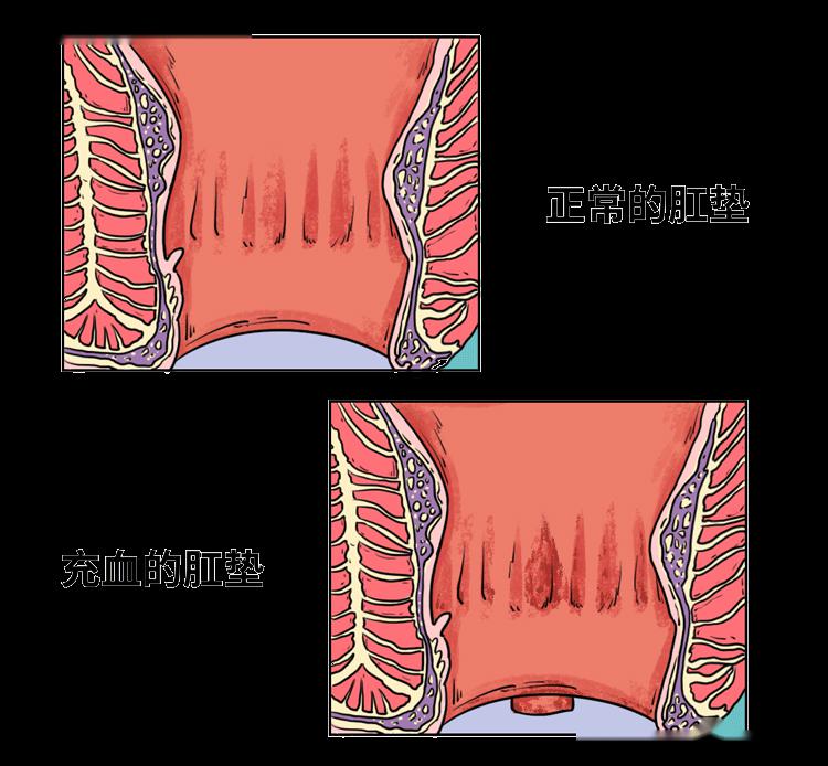 痔瘡就成型了當肛墊充血腫脹而肛門卻只能靠著出口那一圈肛墊硬撐都壓