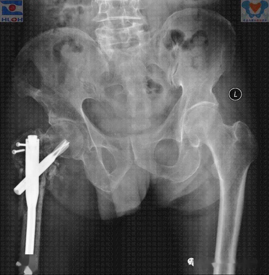 亡羊補牢股骨粗隆間骨折切開復位內固定失效的拯救