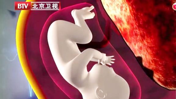 孕妇开始出现频繁宫缩肌瘤快把孩子挤出来了孕妇冒死保胎