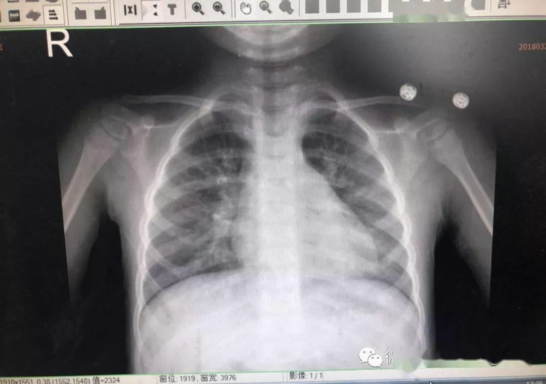 小儿支气管肺炎ct图片图片