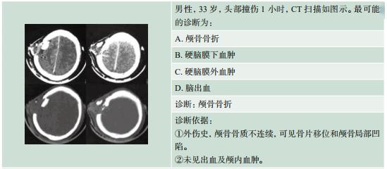 ④穿通性骨折或开放性骨折:显示颅骨缺损和移位的骨折片