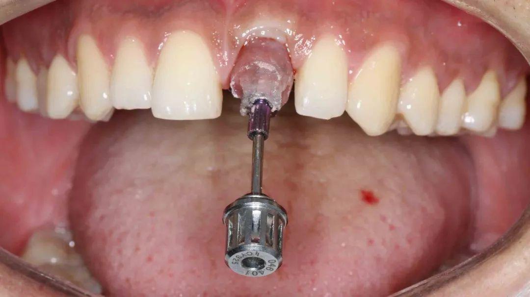 图15 个性化转移杆制取印模图16a 最终修复:全瓷冠戴牙即刻图16b 最终