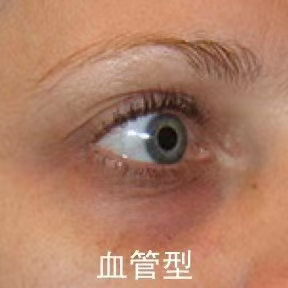 血管型黑眼圈 和充足睡眠有关