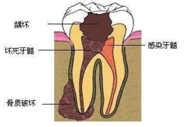 死髓牙和活髓牙图片图片