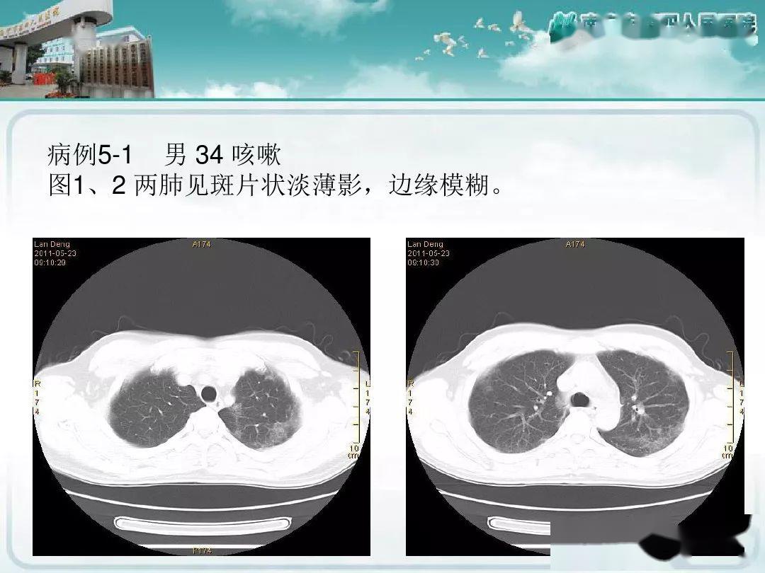 艾滋病相关性的胸部影像学表现