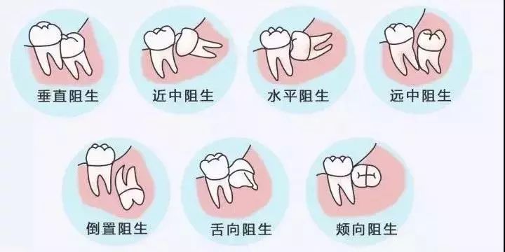 智齿就像你的"旧情人",舍不得拔掉,又时不时作妖……_位置