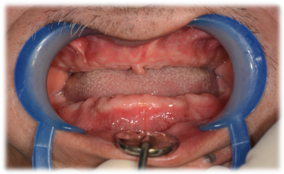 全口缺牙怎么办?无牙颌种植靠谱吗?(高新华怡口腔)_all-on-