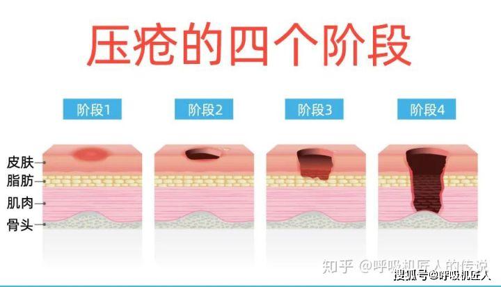 压疮与气垫床:小众领域、科普先行_雅博