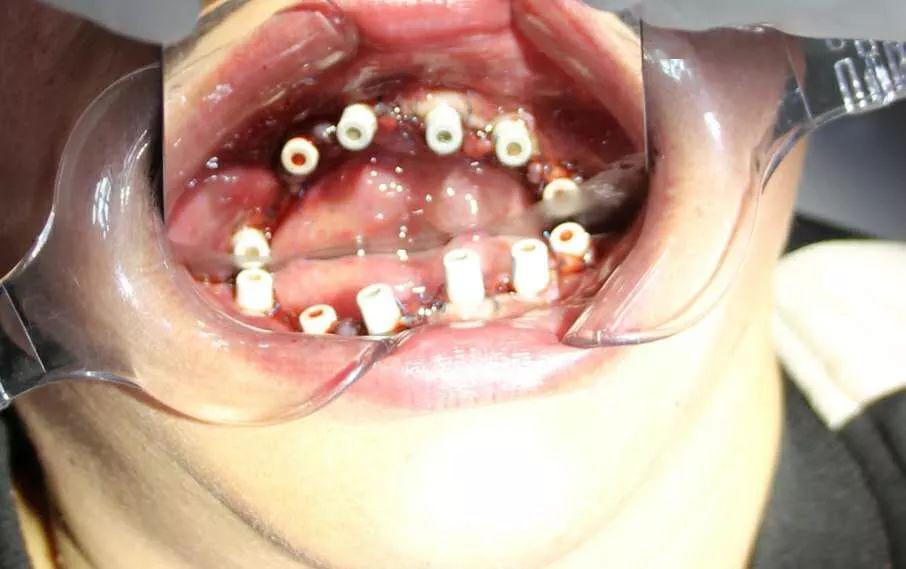 病例关于全口种植即刻拔牙修复案例