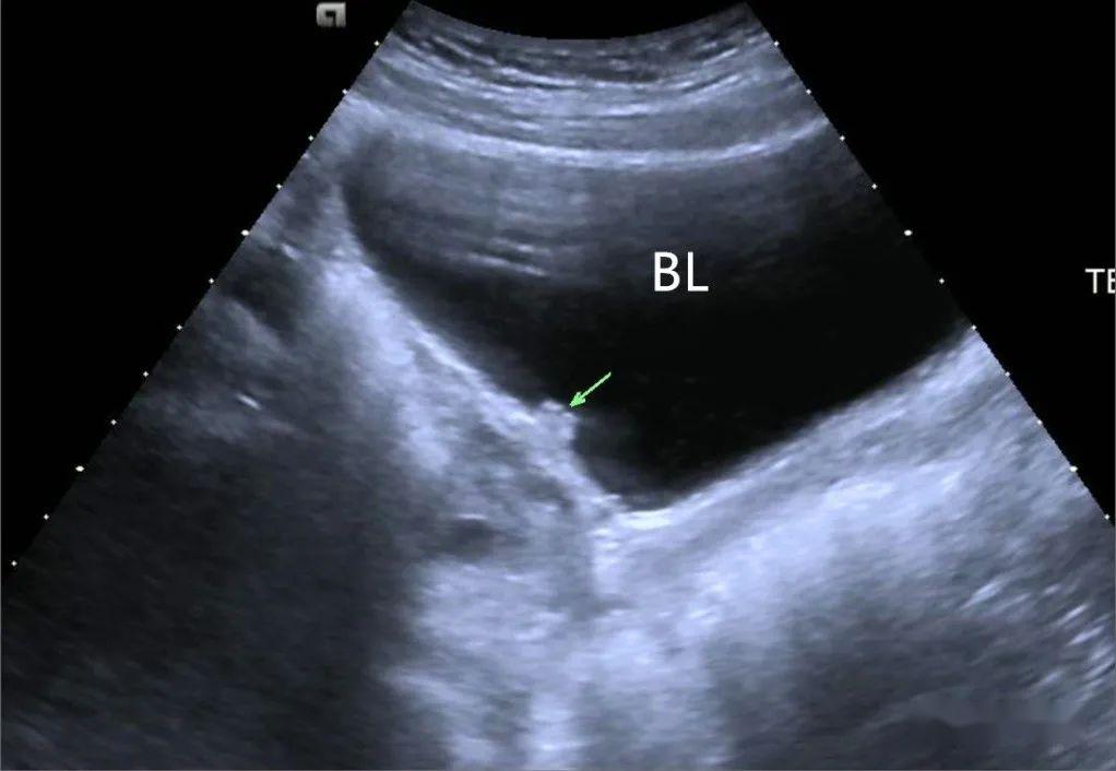 示切迹)泌尿系超声检查发现膀胱三角区双侧输尿管处均见一乳头状突起