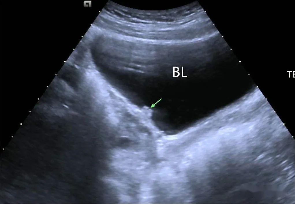 膀胱囊肿超声图片图片