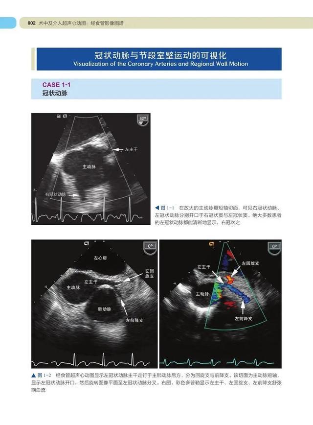 学习tee必备术中及介入超声心动图经食管影像图谱第2版