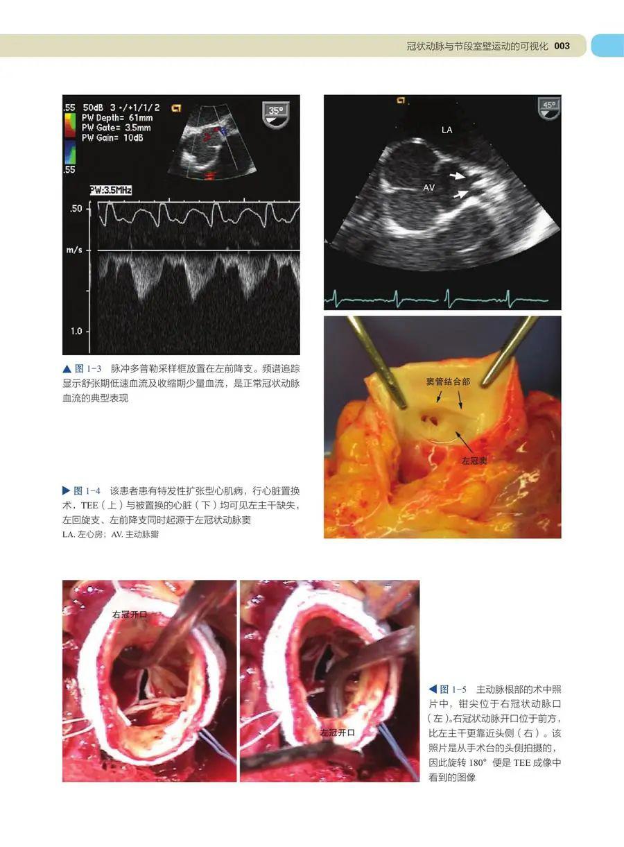 学习tee必备 | 术中及介入超声心动图:经食管影像图谱(第2版)_病例