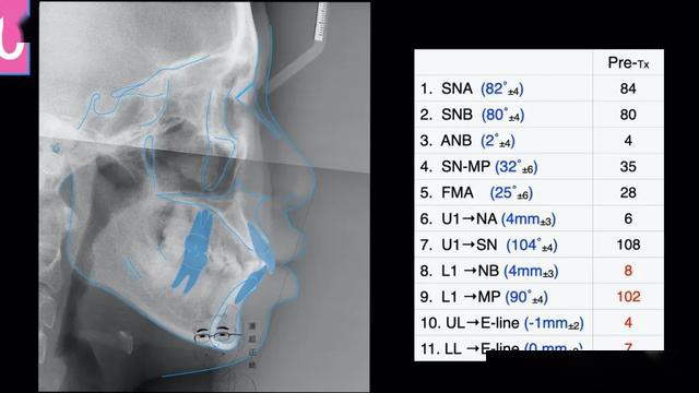 覆盖5mm,覆合3mmspee曲线深约1mm,前牙bolton比:78%,全牙bolton比:92%