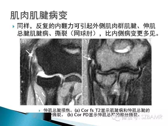 梨状肌横断位图片