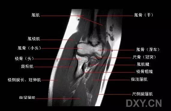 肘關節mri圖譜超全整理