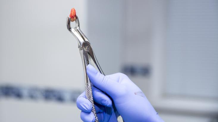 拔牙可能是人们拒绝牙医的一大原因,毕竟谁看到拿着锤子,钳子,挺子的