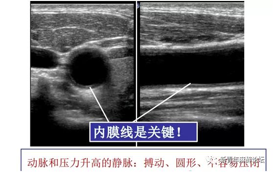 珠江視界宋海波博士超聲引導中心靜脈穿刺置管的規範方法