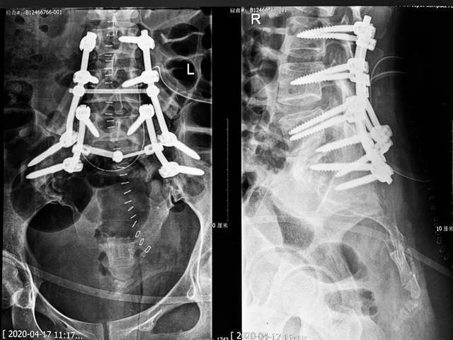 在腰4,腰5椎体与双侧髂骨之间进行骨盆和脊椎连续性重建(生物 机械