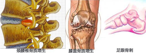 骨质增生症状图片大全图片