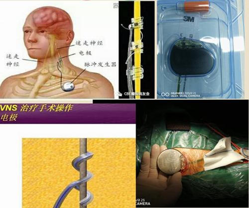 儿童脑积水的克星访郑州大学第三附属医院小儿神经外科主任马云富教授