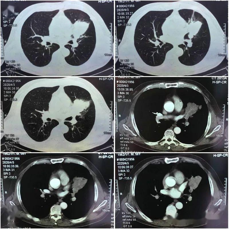我院又成功开展1例高难度胸腔镜下单操作孔左肺上叶