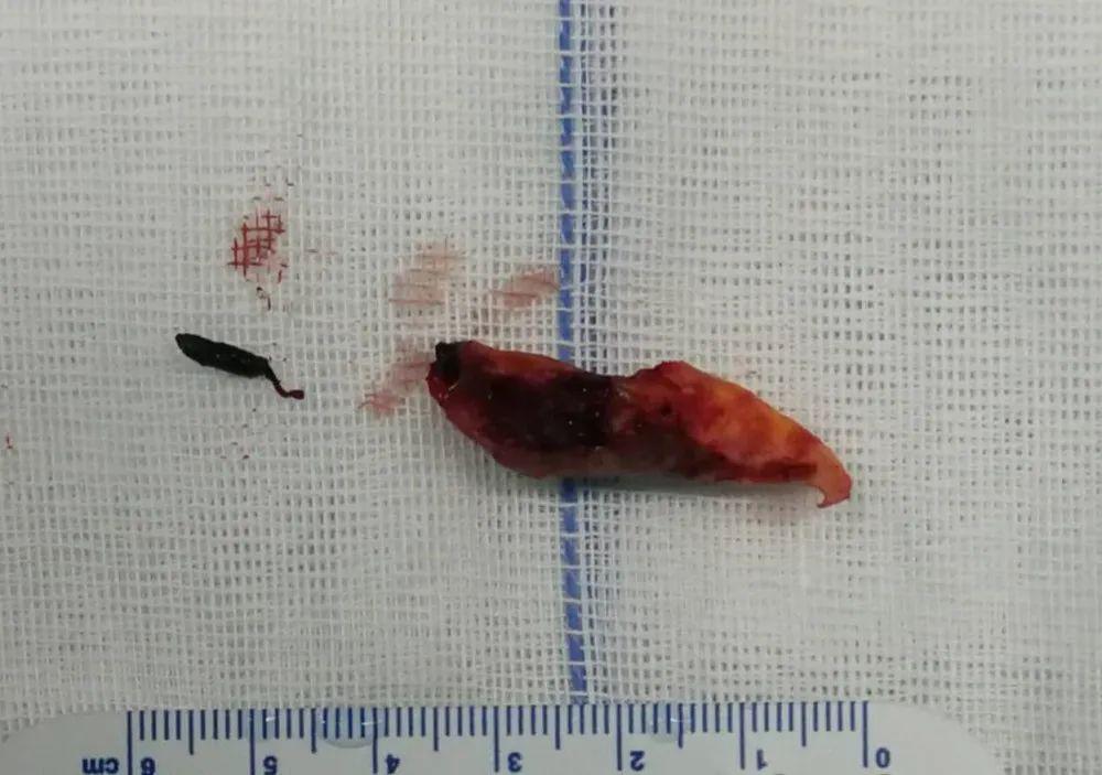 左为颈内动脉陈旧性血栓