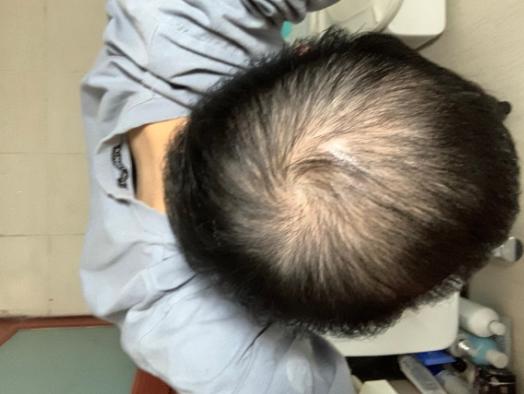 来自雄秃网友自述用了3个月米诺地尔结果越来越秃了