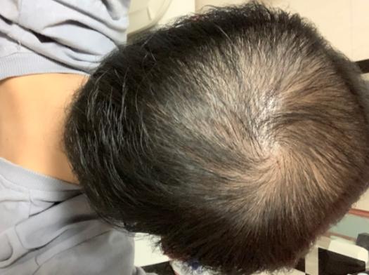 来自雄秃网友自述用了3个月米诺地尔结果越来越秃了