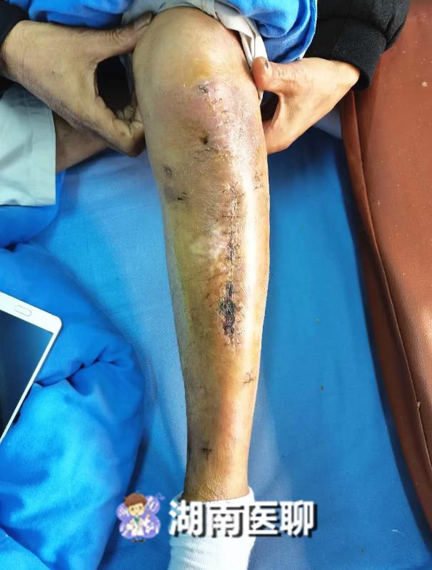 老人摔倒致骨折,生活一直靠拐杖,骨科医生靠这招化解7年之痛