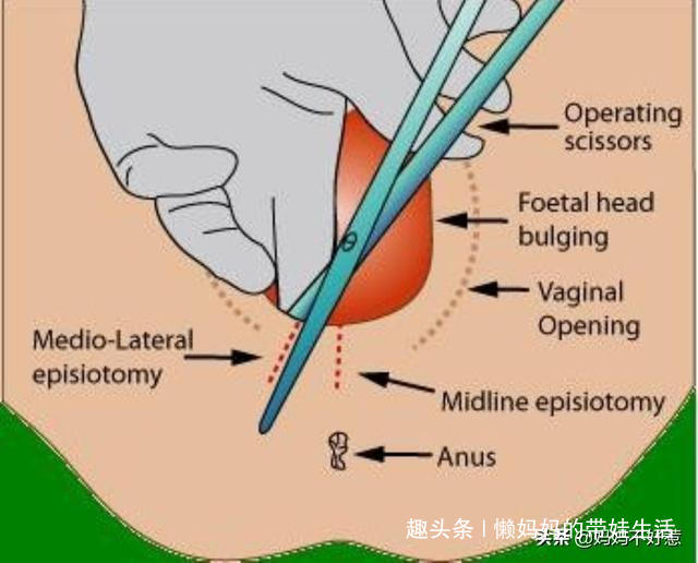 顺产72斤的男宝宝产后坐月子如何护理侧切伤口