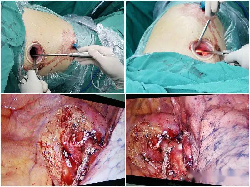 我院又成功开展1例高难度胸腔镜下单操作孔左肺上叶