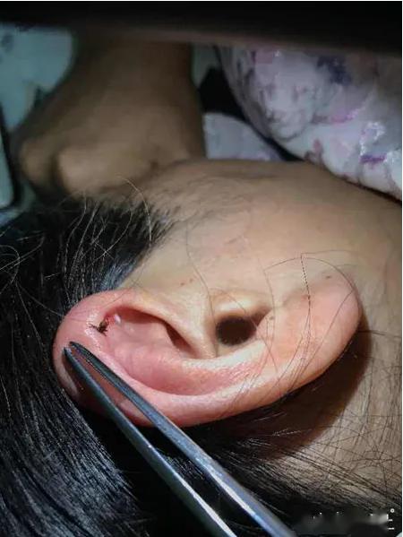 一位患者耳朵被蜱虫死死咬住