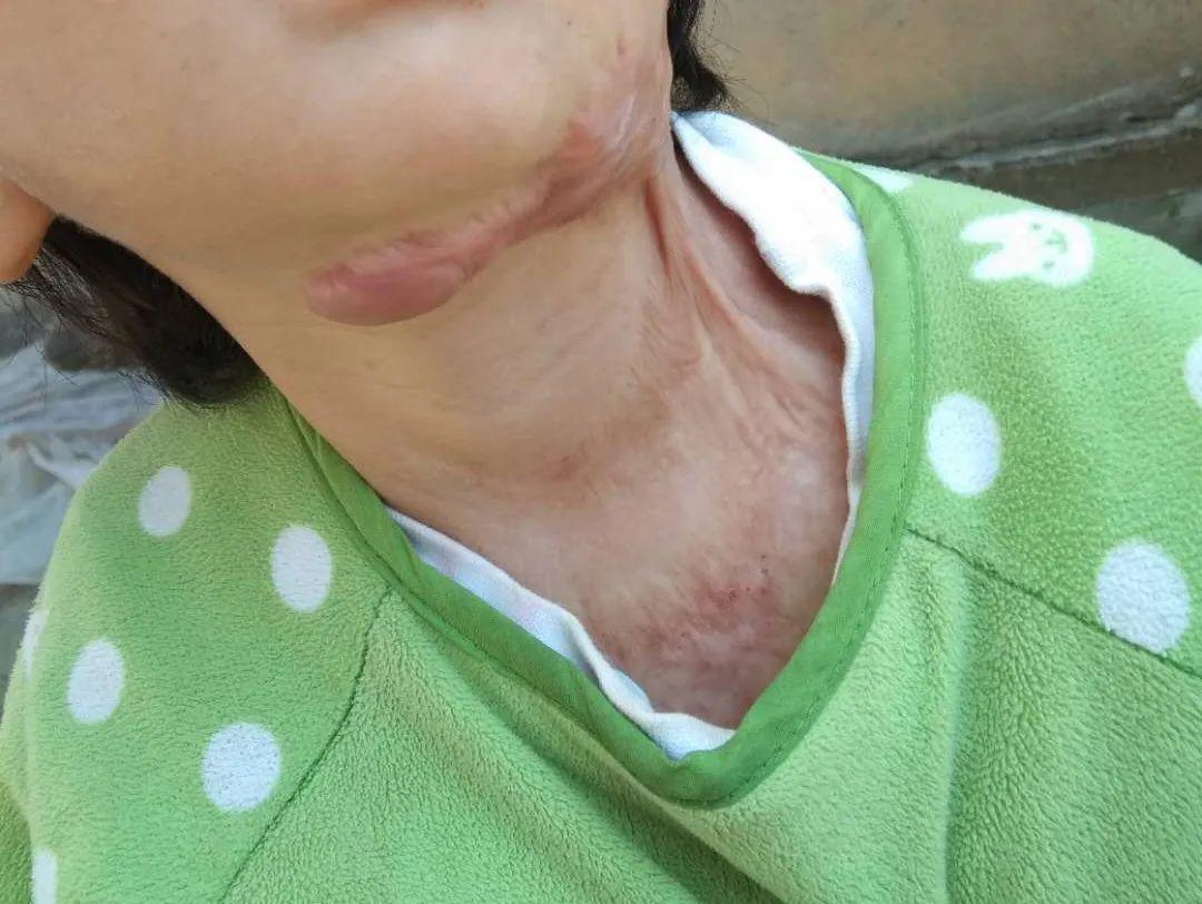 的欣欣不小心被热水烫伤,伤势严重,花费数万元进行治疗,却依旧在脸部