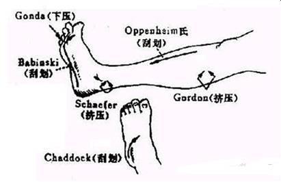 3.強握反射:指檢查者用手指觸摸患者手掌時被強直性握住的一種反射.