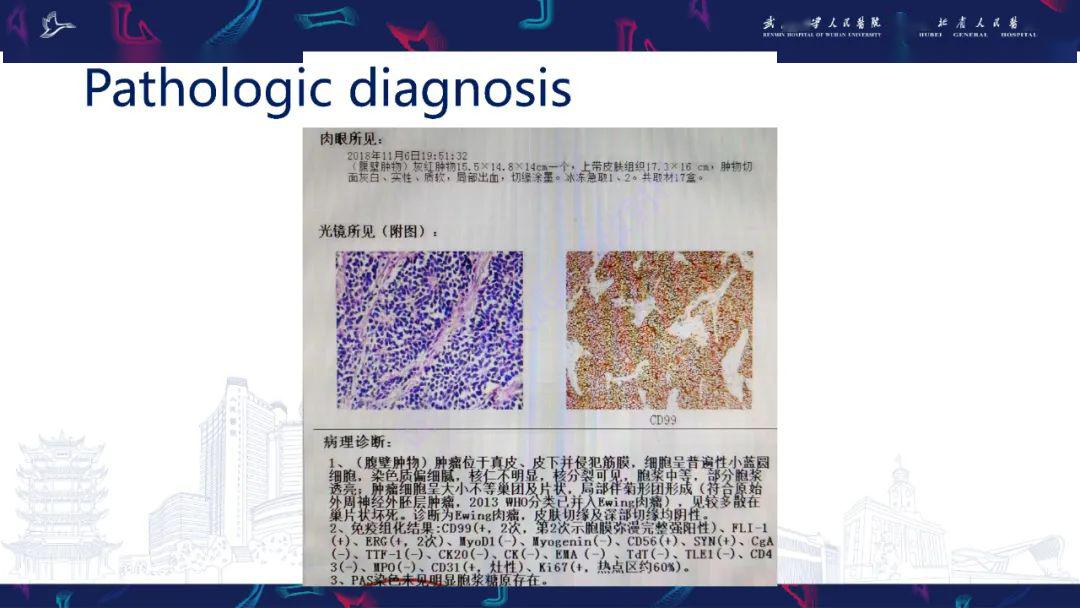 腹壁骨外尤文肉瘤影像诊断