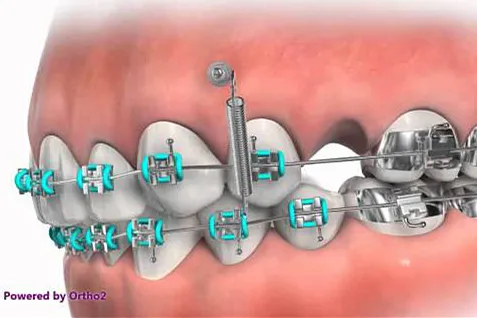 支抗钉植入的位置通常是患者的上颌后牙区,下颌后牙区,硬腭部,牙齿槽