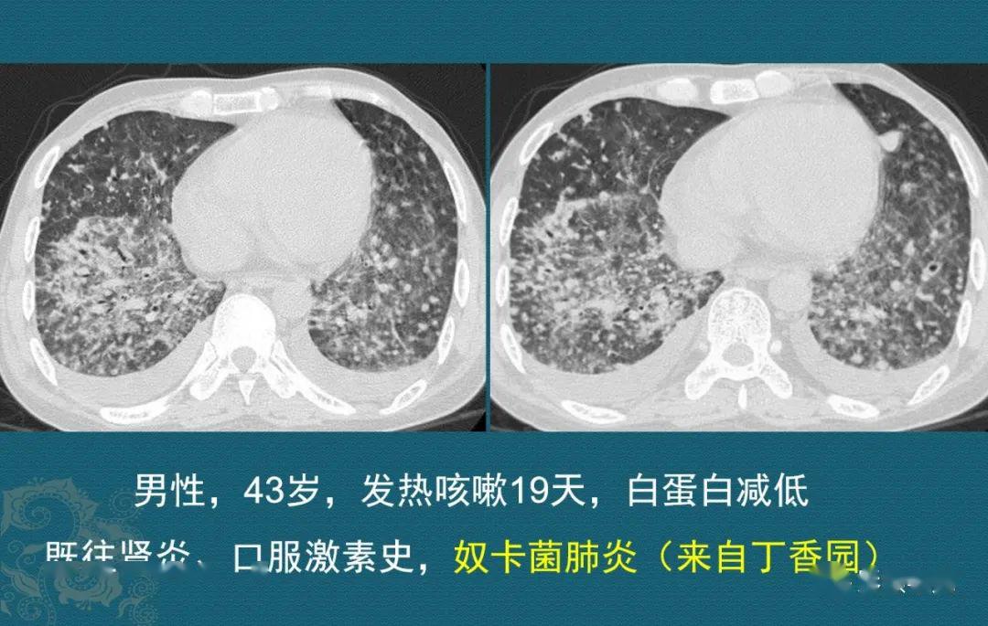 豪哥说肺炎:奴卡菌肺炎趣解