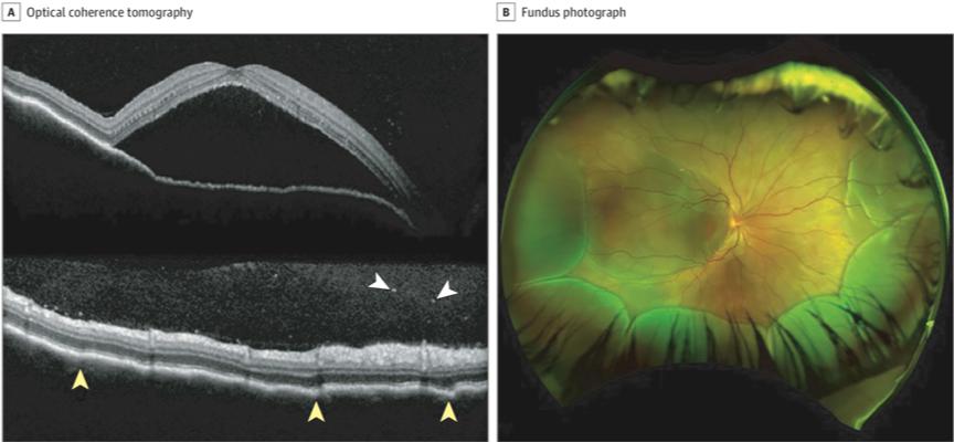 双眼出现玻璃体细胞  ,双眼底广泛视网膜脱离,未见视网膜裂孔(图1b)