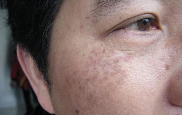 芙拉美叮为你揭秘色斑真相!_黑色素